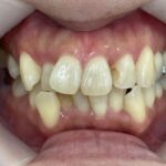 インビザライン治療　症例