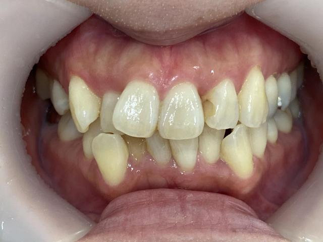 インビザライン治療 症例