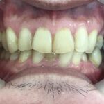 インビザライン治療　症例