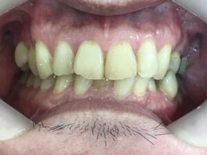 インビザライン治療　症例