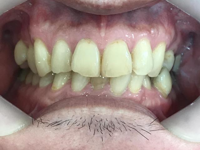 インビザライン治療 症例