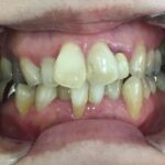 インビザライン治療　症例