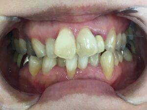 インビザライン治療　症例