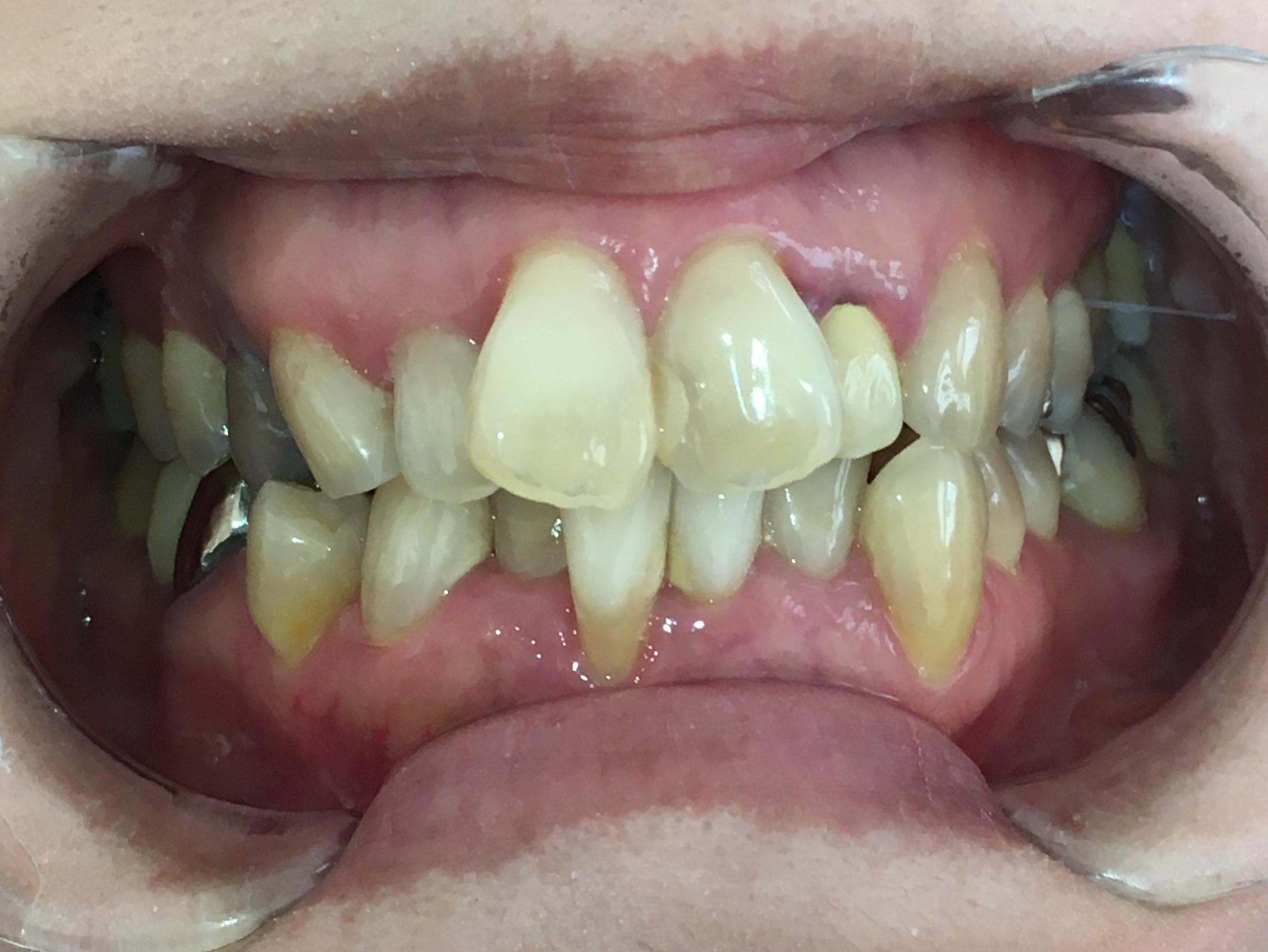 インビザライン治療 症例