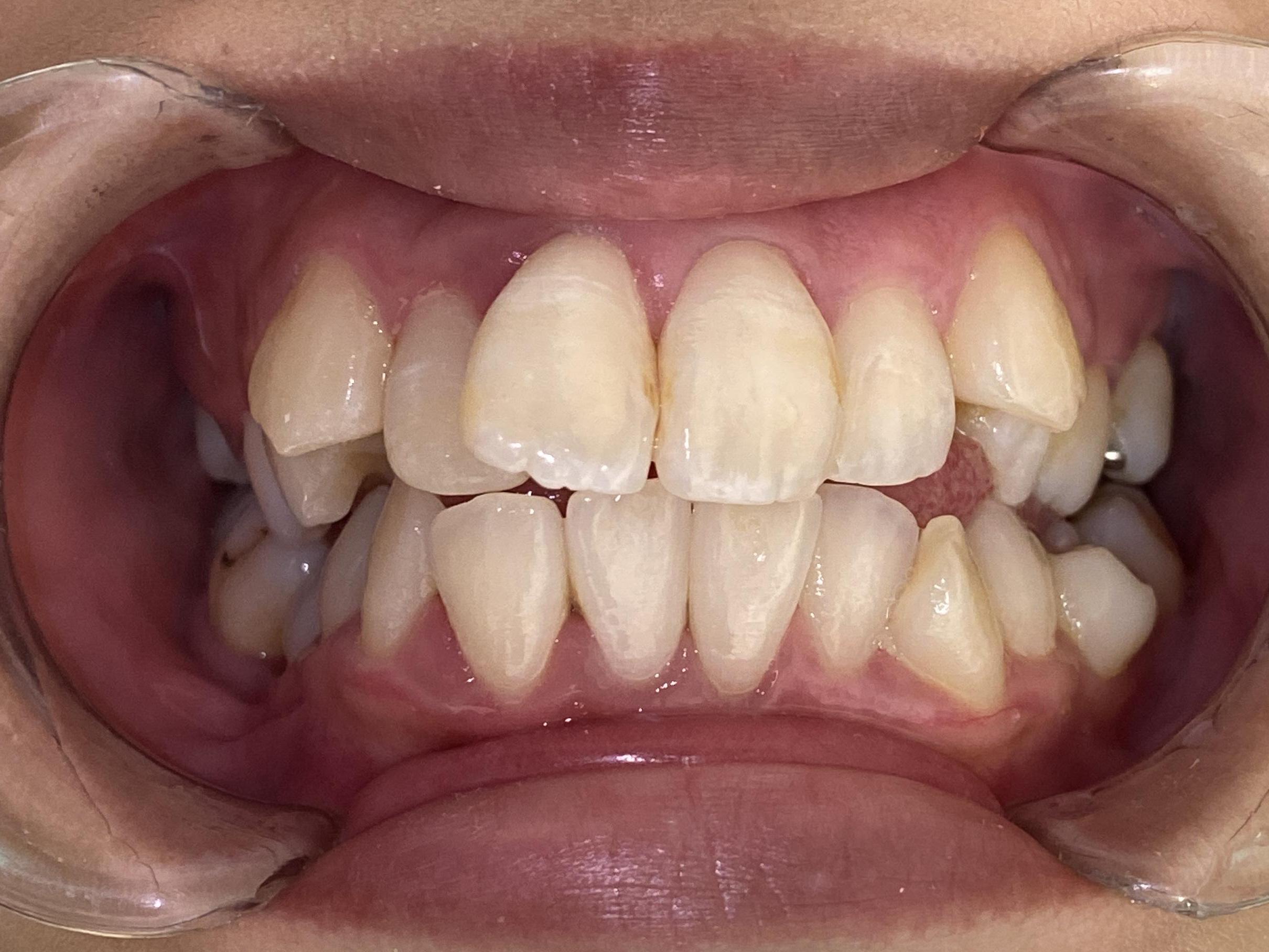 インビザライン治療 症例