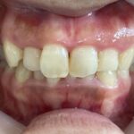 インビザライン治療　症例