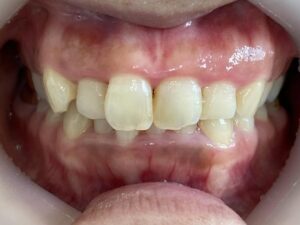 インビザライン治療　症例