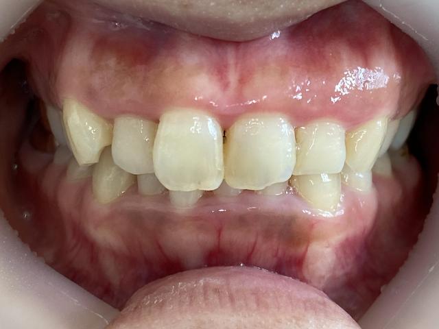 インビザライン治療　症例