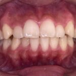 インビザライン治療　症例