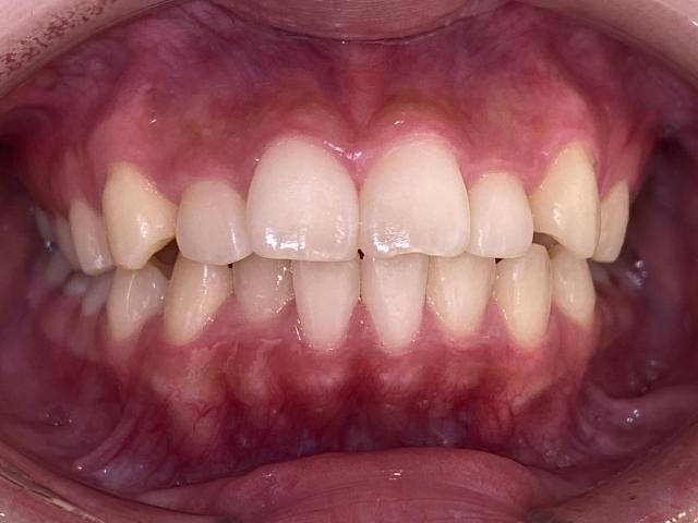 インビザライン治療 症例