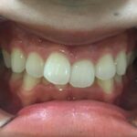 インビザライン治療GO　症例