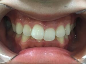 インビザライン治療GO　症例