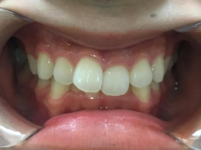 インビザライン治療GO 症例