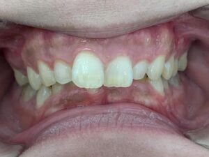 インビザライン治療　症例