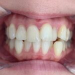 インビザライン治療GO　症例