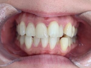 インビザライン治療GO　症例