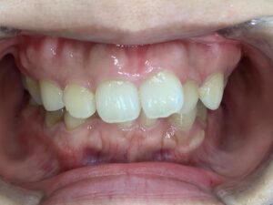 インビザライン治療GO　症例
