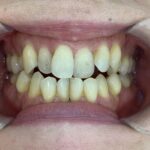 インビザライン治療GO　症例