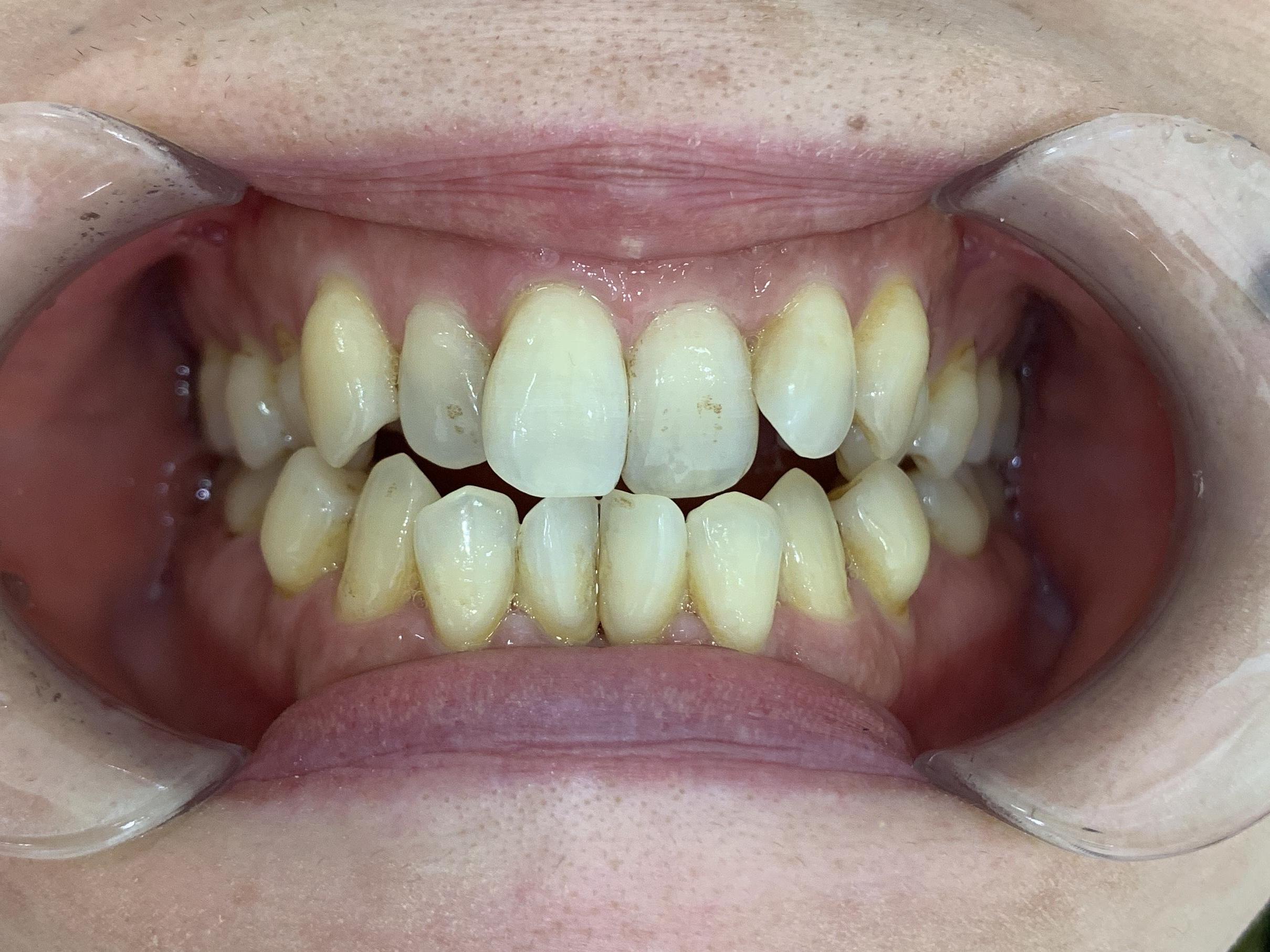 インビザライン治療GO 症例