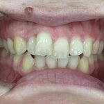 インビザライン治療GO　症例