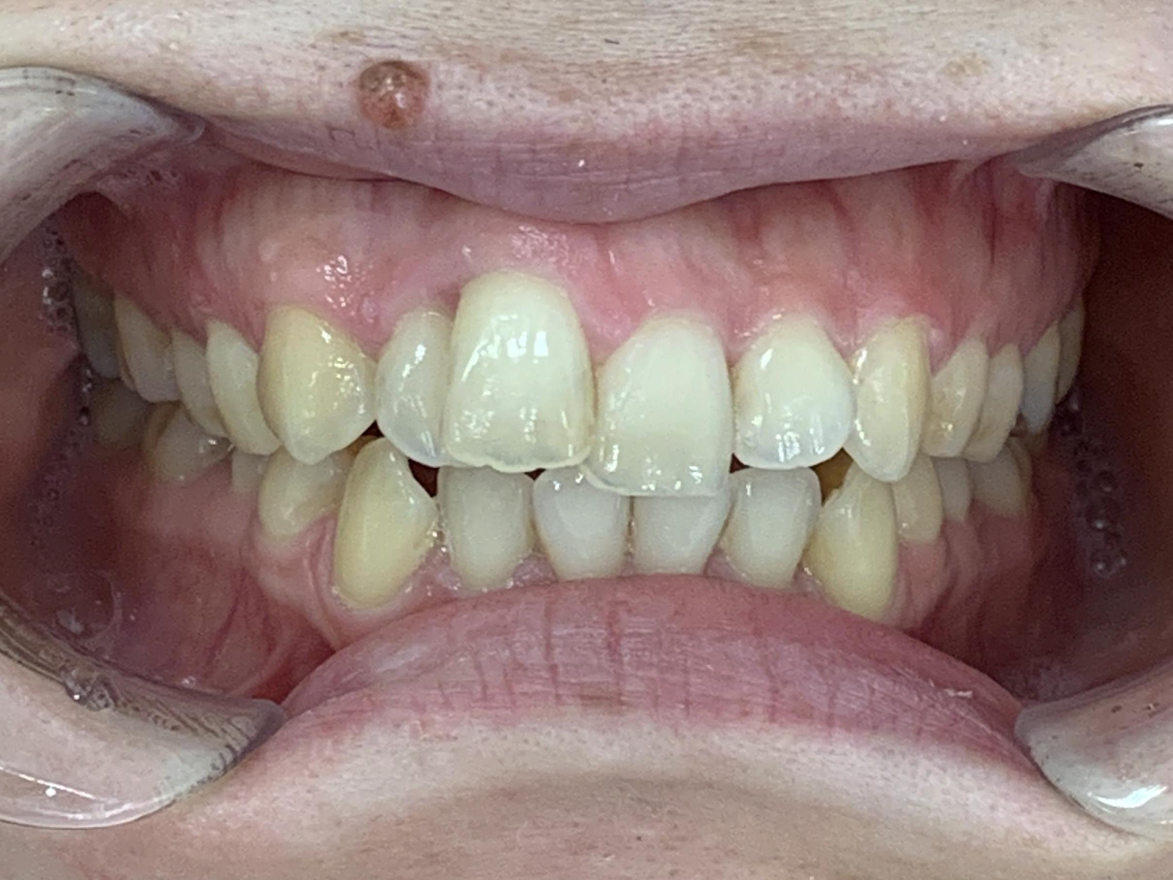 インビザライン治療GO 症例