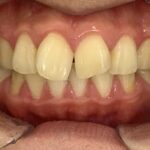 インビザライン治療GO　症例