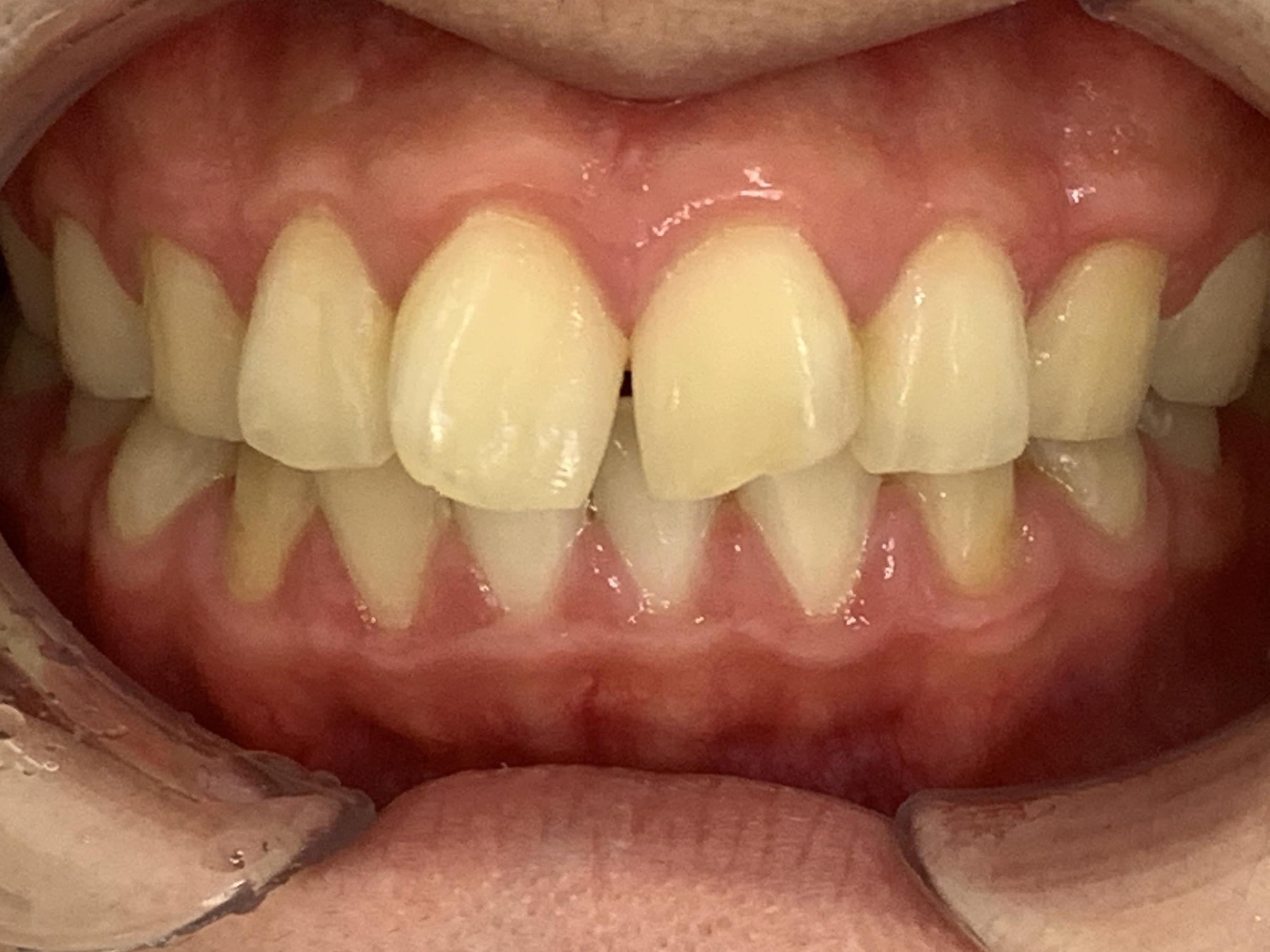 インビザライン治療GO 症例