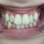 インビザライン治療GO　症例