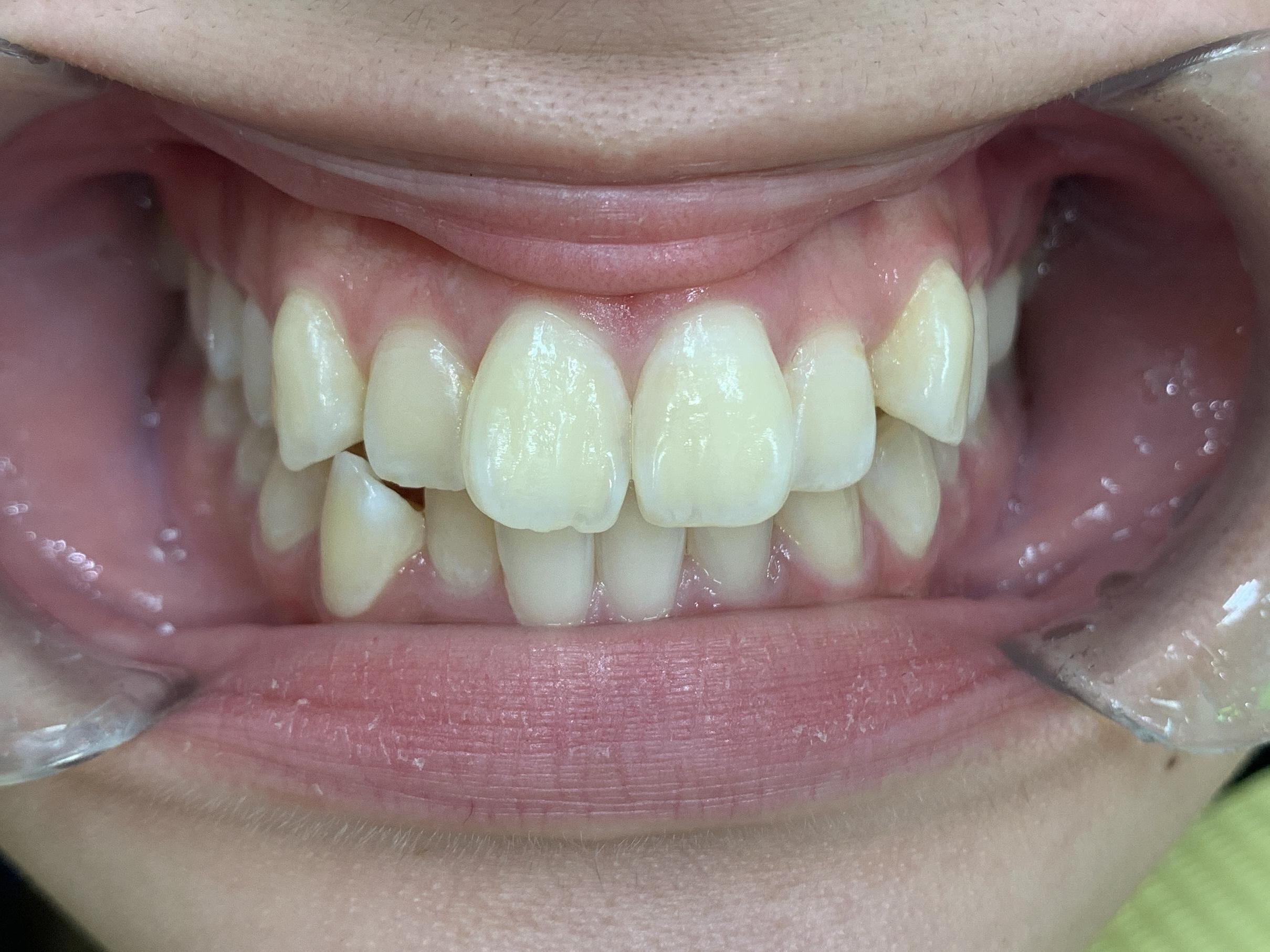 インビザライン治療GO 症例