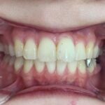 インビザライン治療GO　症例