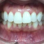 インビザライン治療GO　症例