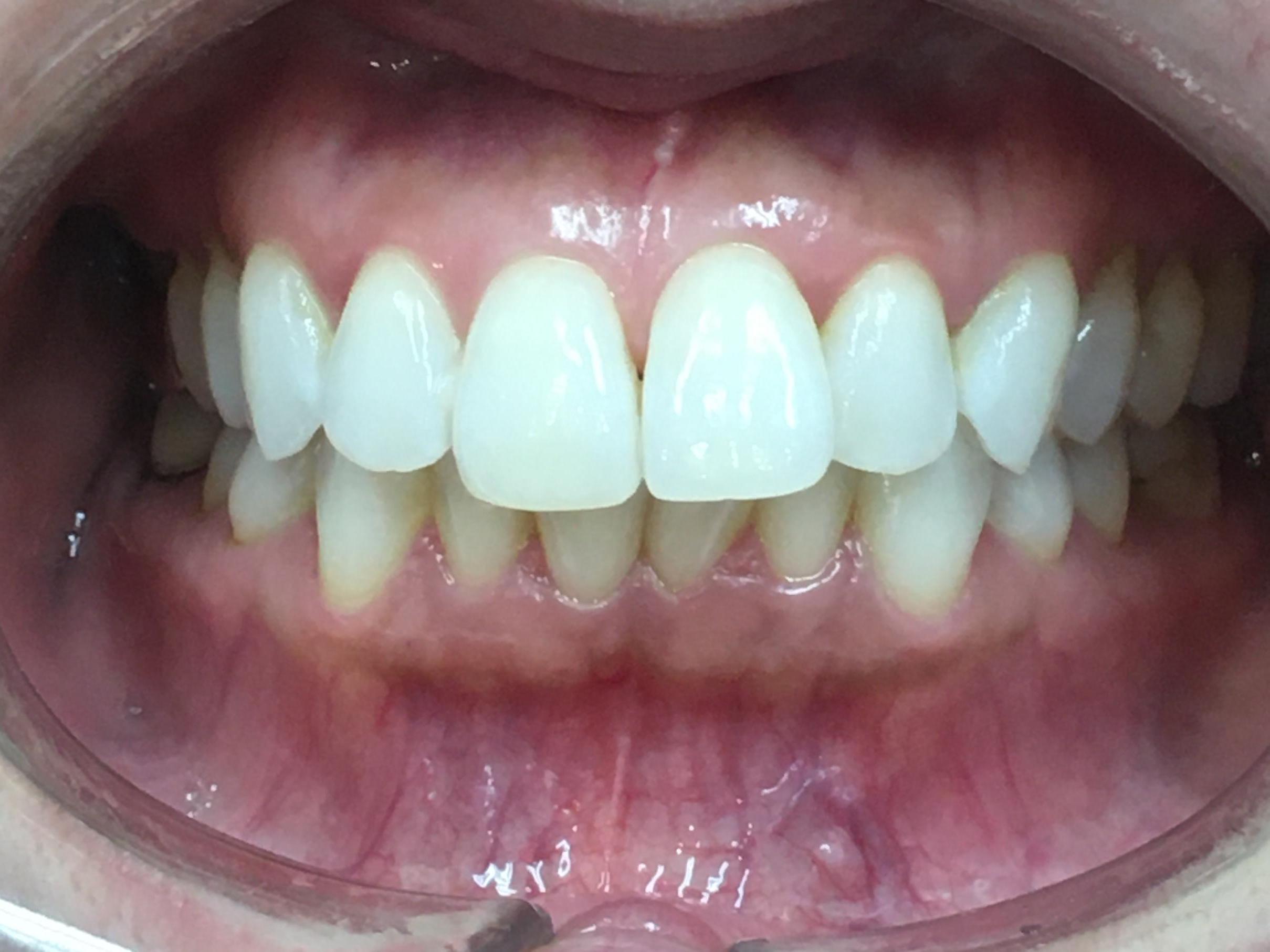 インビザライン治療GO　症例