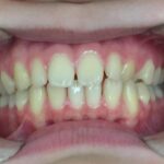 インビザライン治療GO　症例