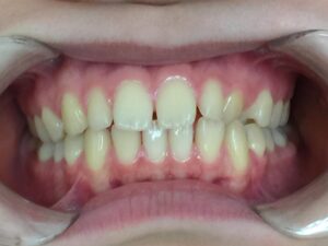 インビザライン治療GO　症例