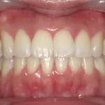 ホワイトニング　症例