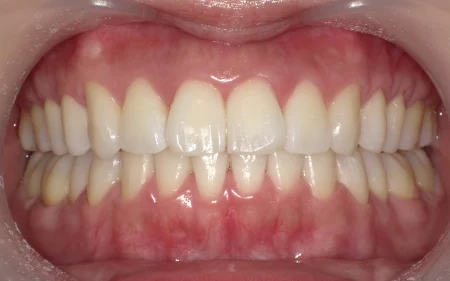 ホワイトニング 症例