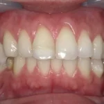 ホワイトニング　症例