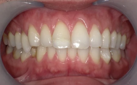 ホワイトニング 症例