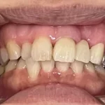 セラミック　症例