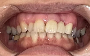 セラミック　症例