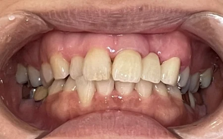 セラミック　症例