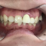 インビザライン治療　症例