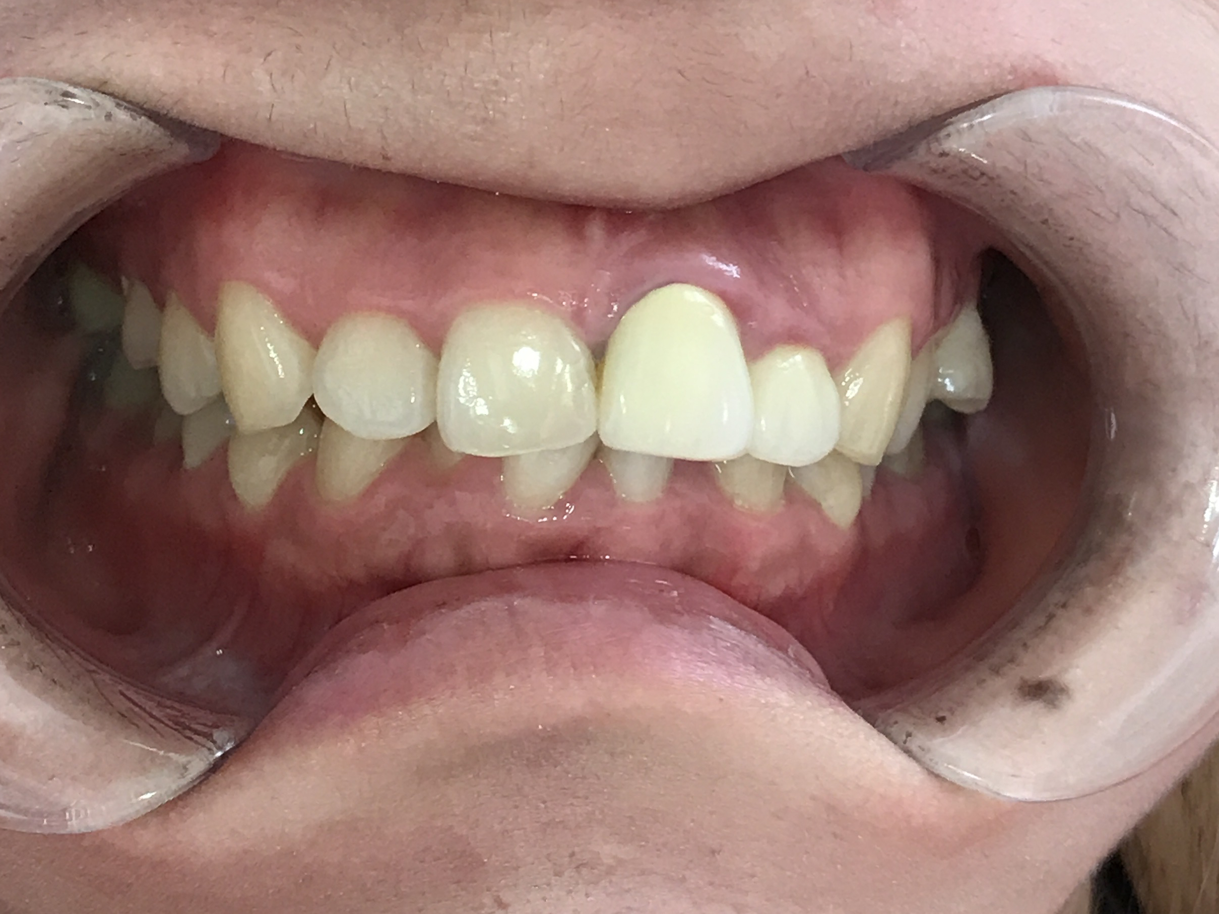 インビザライン治療　症例