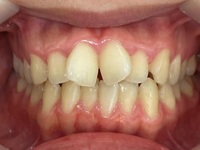 インビザライン治療 症例