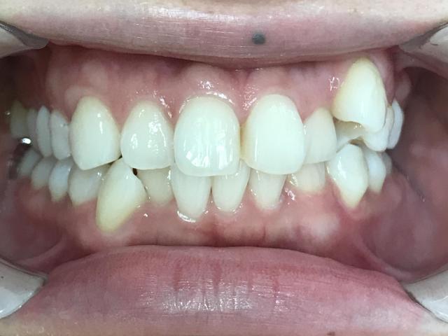 インビザライン治療　症例