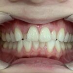 インビザライン治療　症例