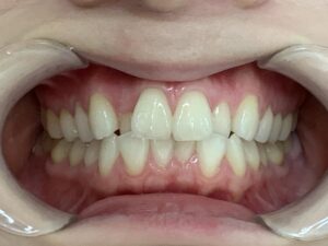 インビザライン治療　症例