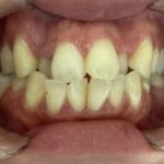 インビザライン治療　症例