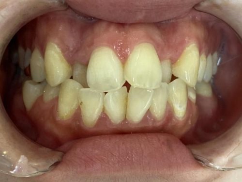 インビザライン治療 症例