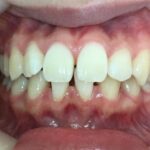 インビザライン治療　症例